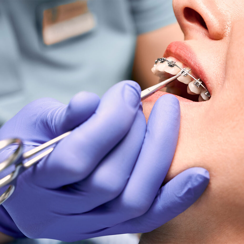 consecuencias ortondoncia brackets novadent